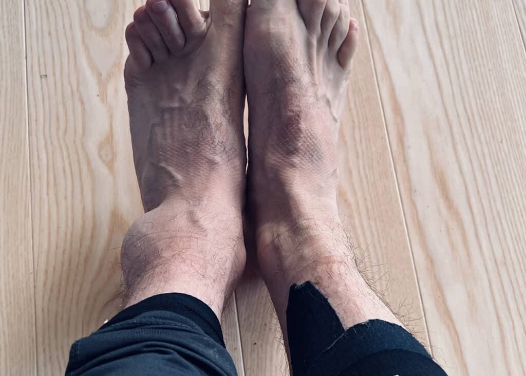 Hævet og misfarvet ankel få timer efter et kraftigt vrid.