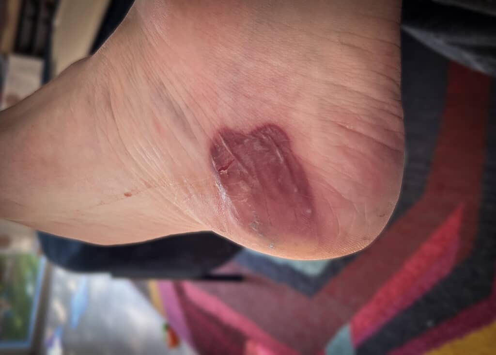Blodvabel under hælen efter et marathonløb.