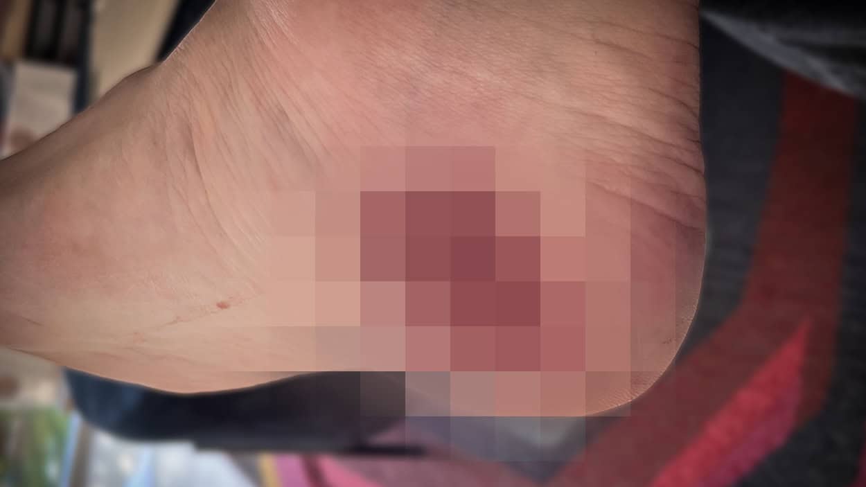 Løbeskader: Fire personlige erfaringer – Advarsel! Indeholder billeder af skader